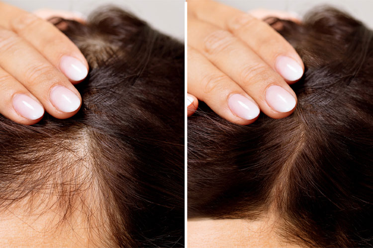 درمان ریزش مو در زنان با داروهای تقویتی رشد مو